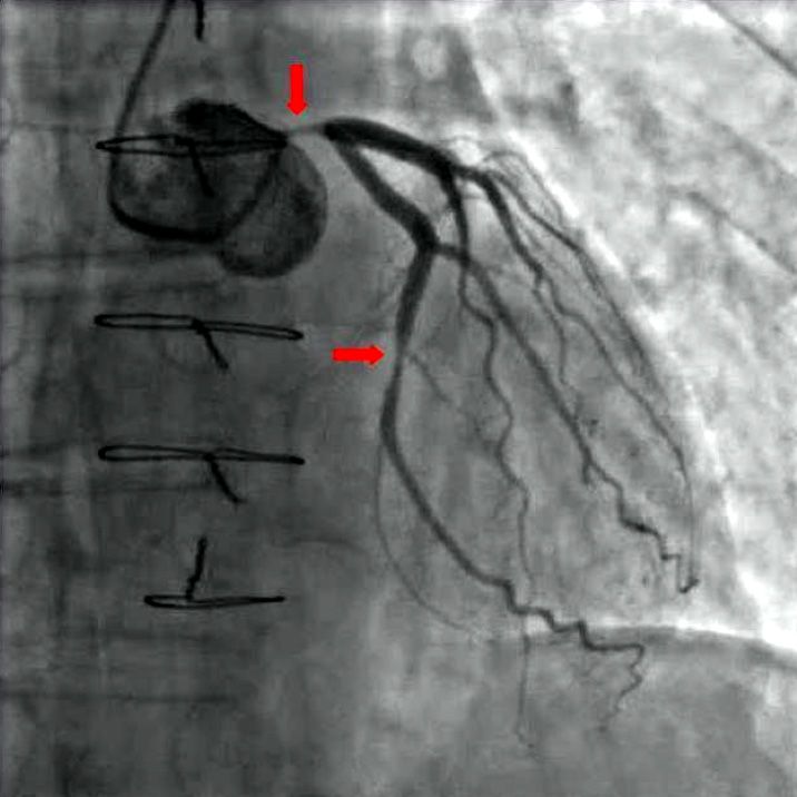 cin Angiography_coronary_stenosis_01